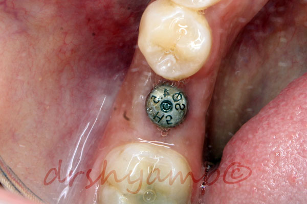 single tooth dental implant