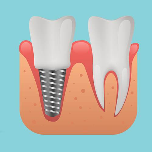 Dental Implants 